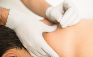 dry needling centennial colorado chiropractor